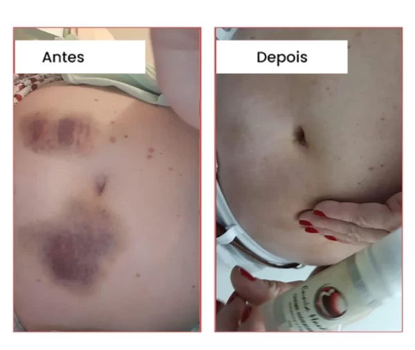 Clareador em Hematomas