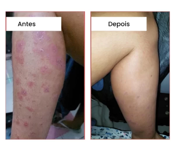 Psoríase nas pernas